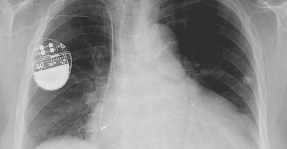 Who Killed the Rechargeable Pacemaker? - The Atlantic