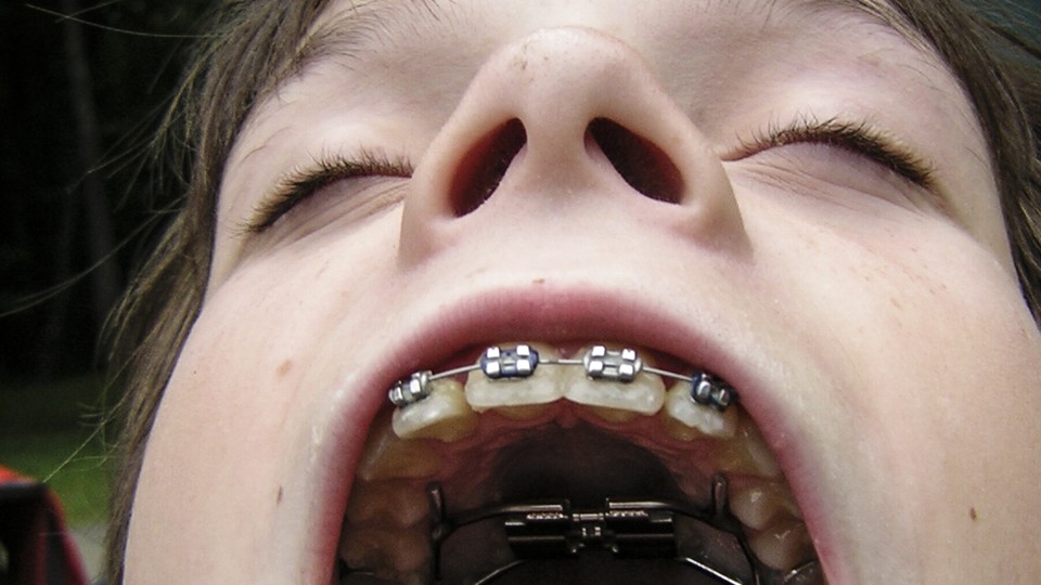 The History Of Braces An Object Lesson The Atlantic 