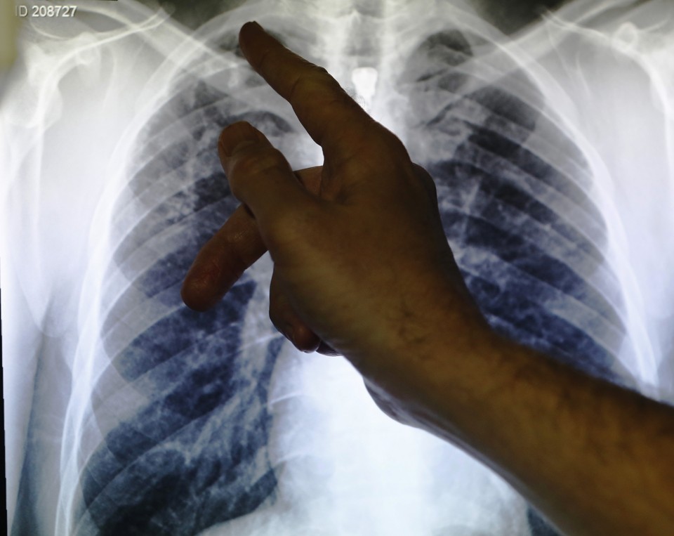 The Danger of Ignoring Tuberculosis The Atlantic