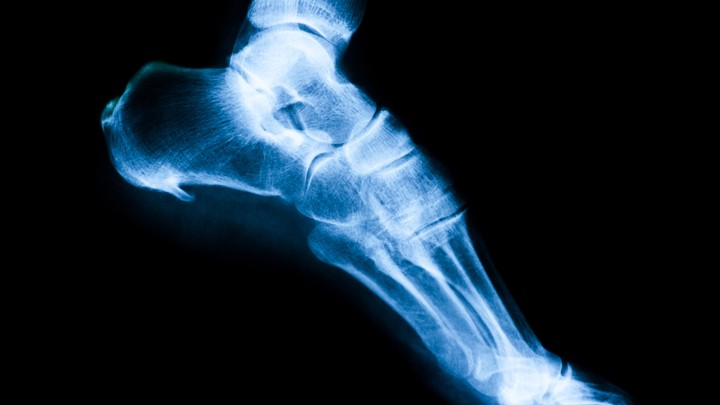 Image result for trump bone spur foot