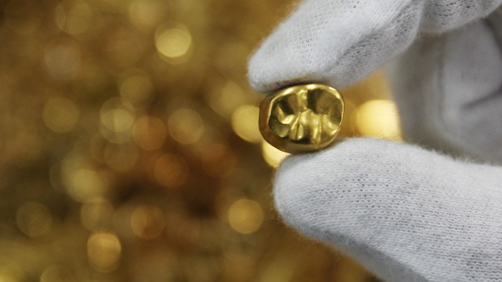 A gold tooth