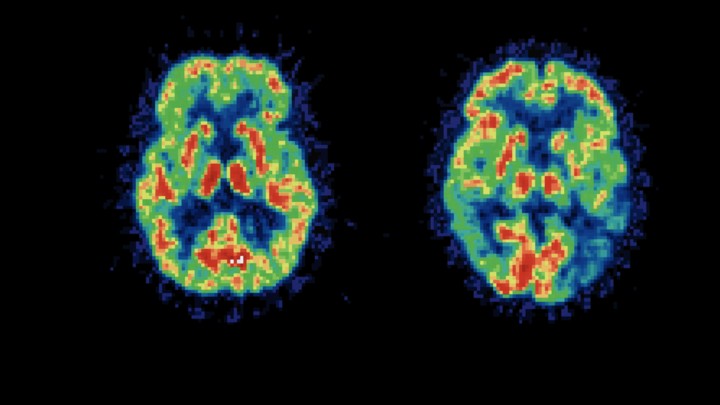 Brain scans