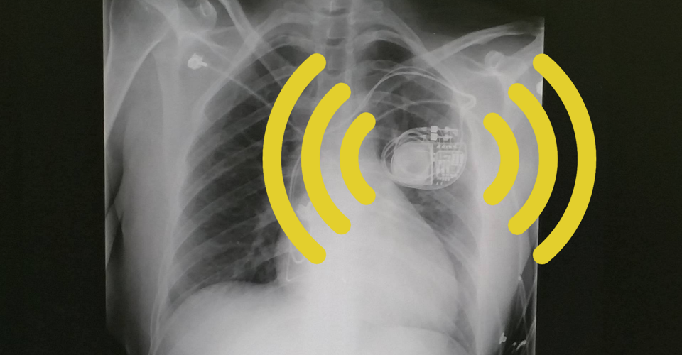 My Pacemaker Is Tracking Me From Inside My Body The Atlantic