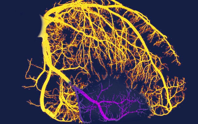 A visualization of the arteries of someone with heart disease