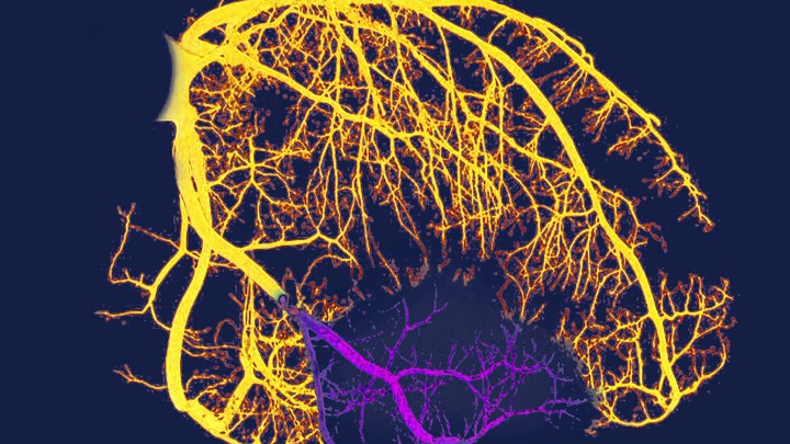 A visualization of the arteries of someone with heart disease