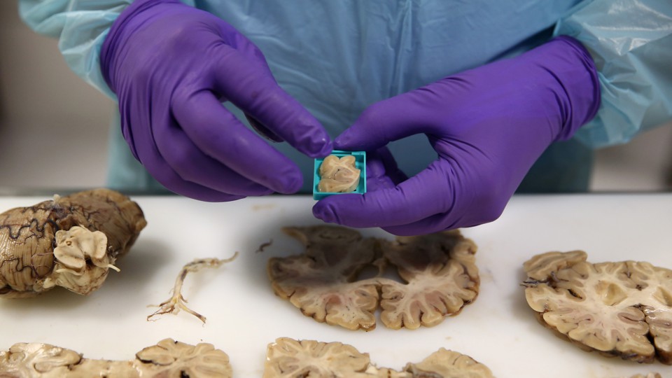 A scientist wearing purple gloves prepares a tissue sample from a dissected human brain.