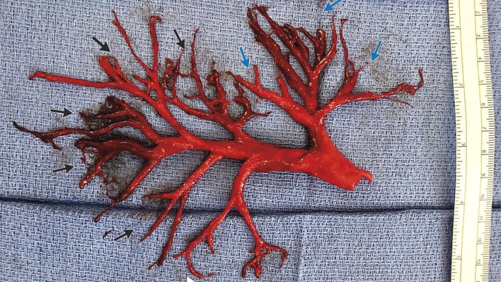 A blood-clot cast of the right bronchial tree
