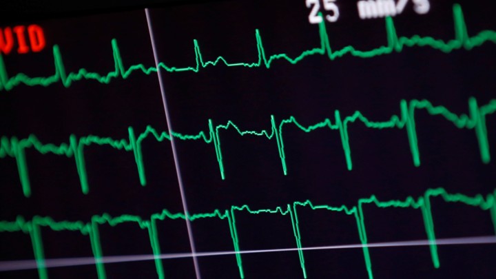 An EKG readout