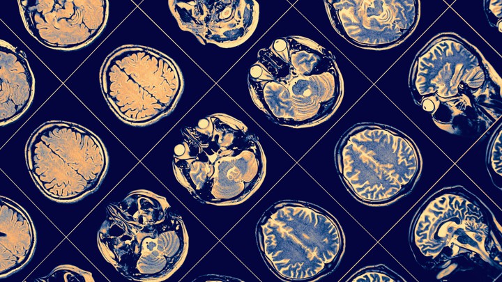 Halting Schizophrenia Before It Starts >> Can Schizophrenia Be Stopped The Atlantic Halting Schizophrenia Before It Starts >> Can Schizophrenia Be Stopped The Atlantic