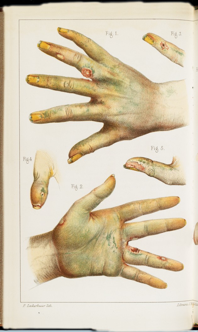 Bitten By Witch Fever Why Poison Was Everywhere In The Victorian