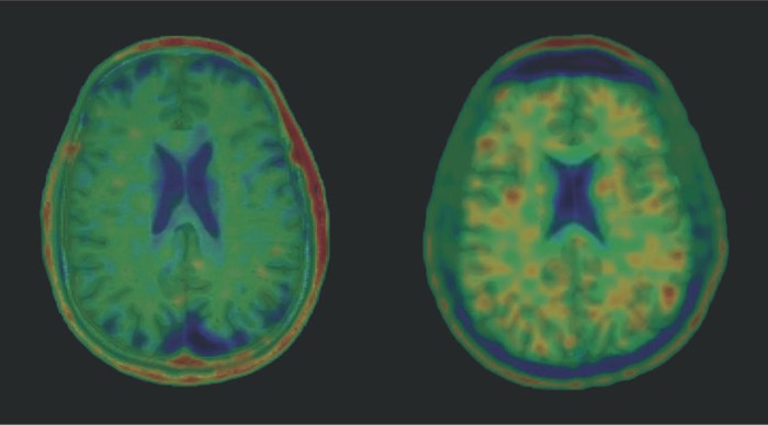 Axial images of T1-weighted MRI overlaid with [18F]AV-1451/T807 PET in a healthy control (left) and in a National Football League (NFL) player with a history of 22 concussions and clinically probable chronic traumatic encephalopathy (CTE; right)