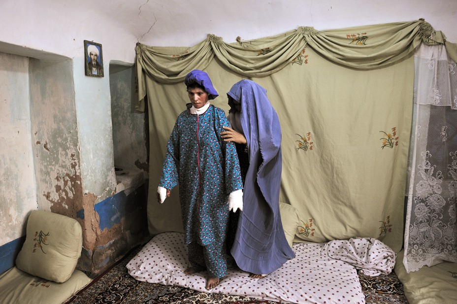 A young woman with burns on her body is helped by her mother