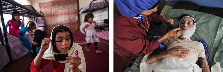 Left: A in a shelter puts on make up on her scarred face. Right: a woman with a bandanged body and face is helped to drink.