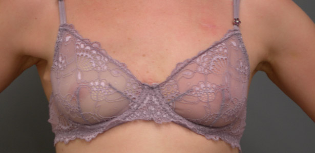 After mastectomy reconstruction no Why These