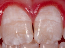 2teeth-fluorosis-thumb-250x185-77494-thumb-270x199-77495.jpg