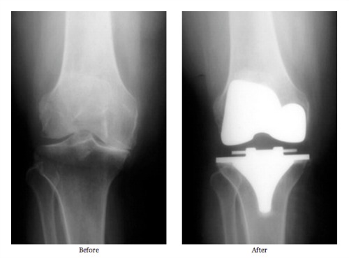 Would Knee Replacements Make Me Taller? - The Atlantic