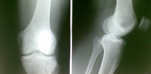 knee xray 615.jpg