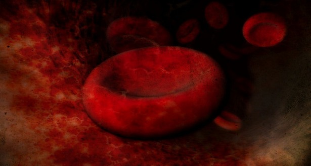 hemochromatosis eye