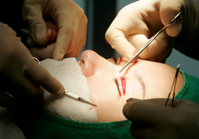 Eyelid Surgery The Woodlands