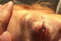 The sun shining on someone's eye, with a hand on their forehead