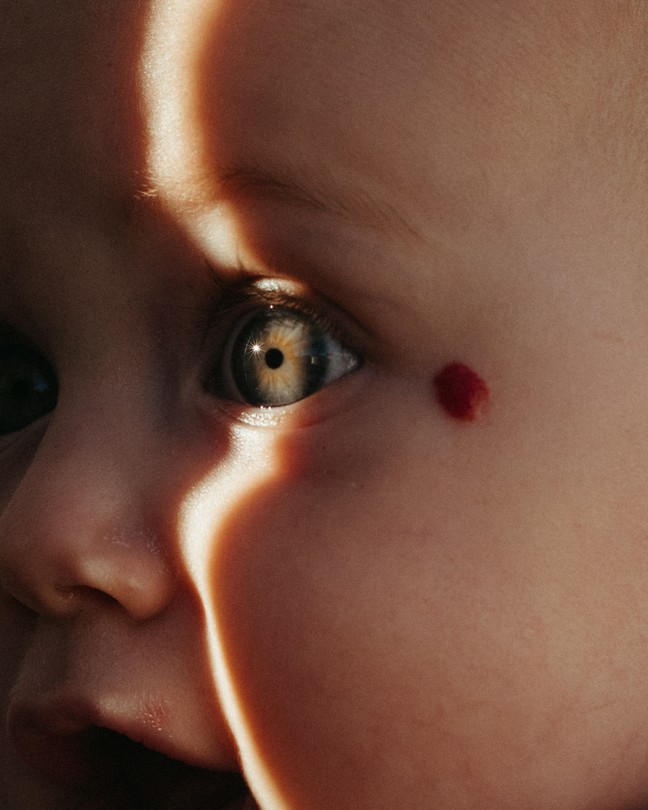 A photo of a baby with fair skin, green eyes, and a red mark next to their left eye. A line of sunlight cuts vertically through their face and left eye.