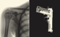 An image splice of an X-ray of a shoulder with a bullet lodged in it (left) and a handgun (right)