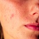 A close-up of a woman's face with acne