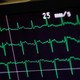 An EKG readout