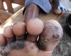 sand flea bites on feet