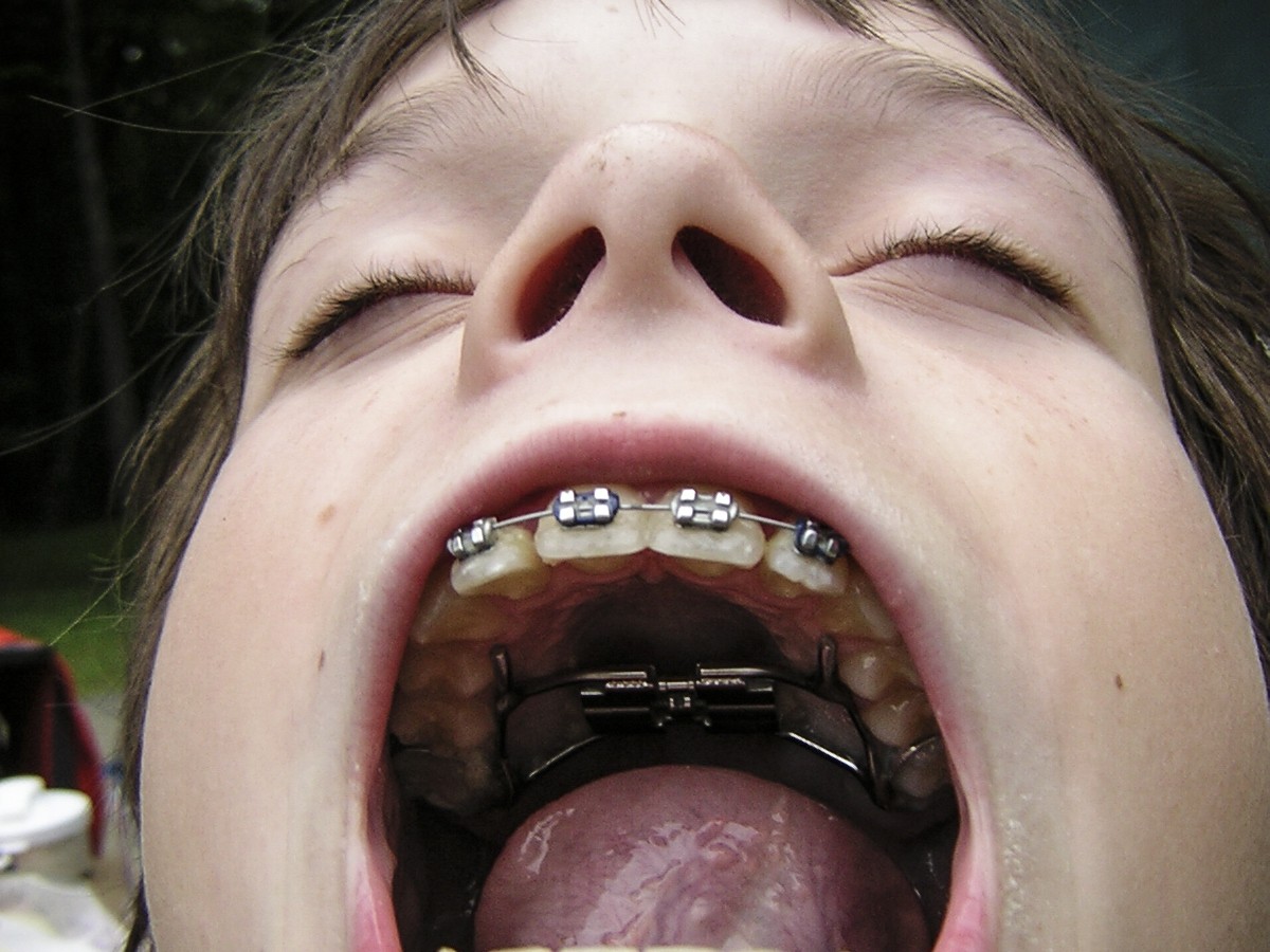 childrens braces