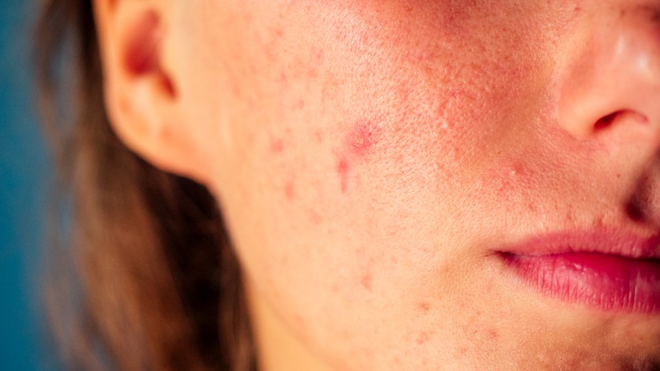 A close-up of a woman's face with acne
