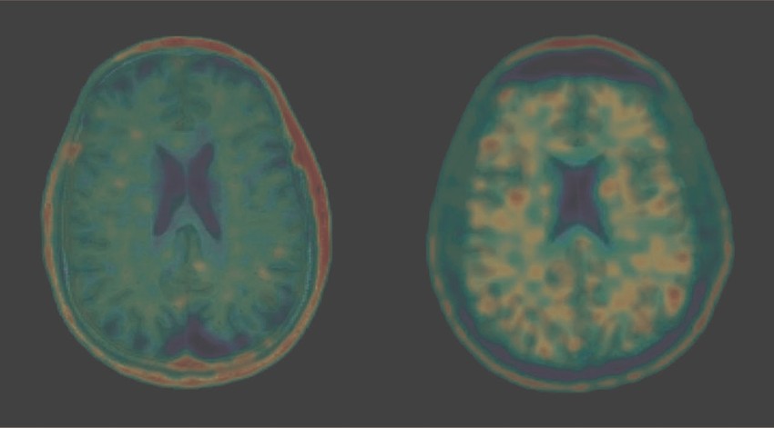 Will a New Way to Diagnose CTE Change Football? - The Atlantic