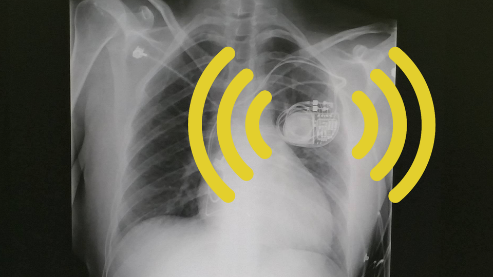 An X-ray of a chest showing a pacemaker overlaid with yellow Wi-Fi-style lines emanating from the pacemaker