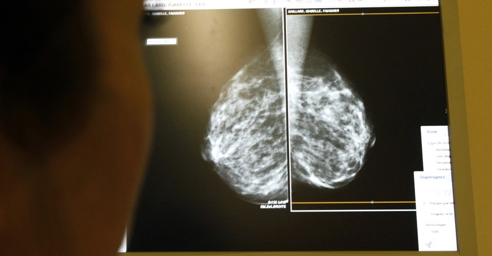 What Dense Breasts Mean for Cancer Risk - The Atlantic