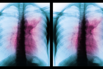 two side-by-side colored x-rays of lungs with opacity in the middle, indicating TB infection