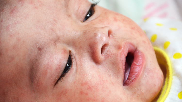The Return of Measles Is a Failure of Communication - The Atlantic