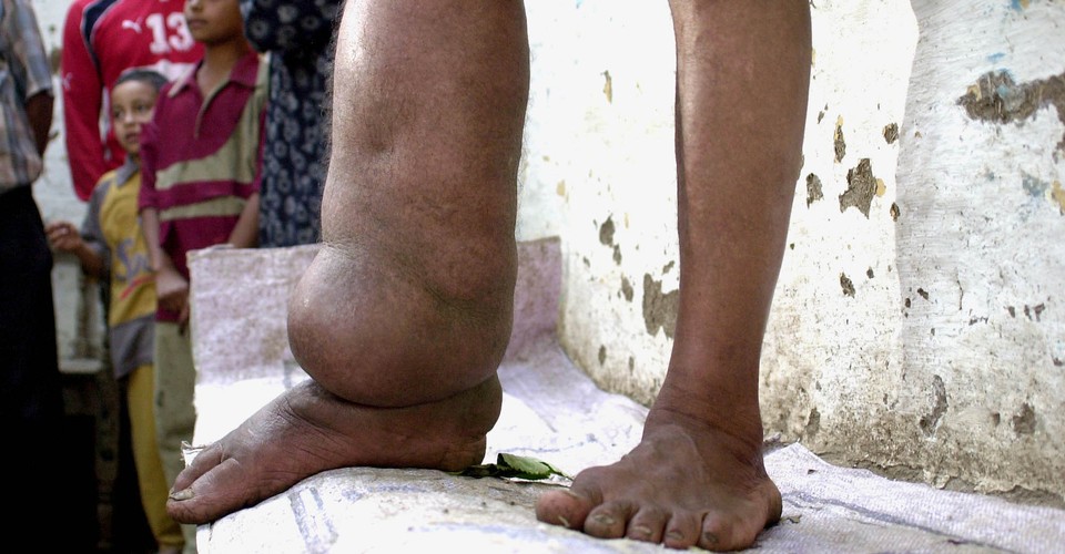 what-is-elephantiasis-the-disease-cured-by-the-nobel-prize-winning