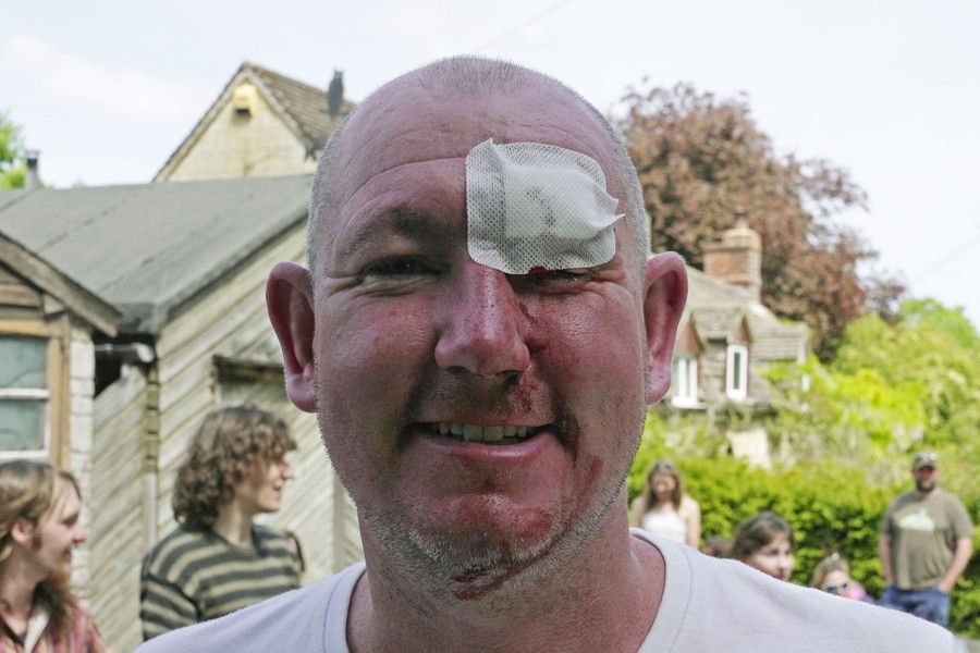 A man smiles for the camera, with a bandage over his left eye and dried blood on his face.