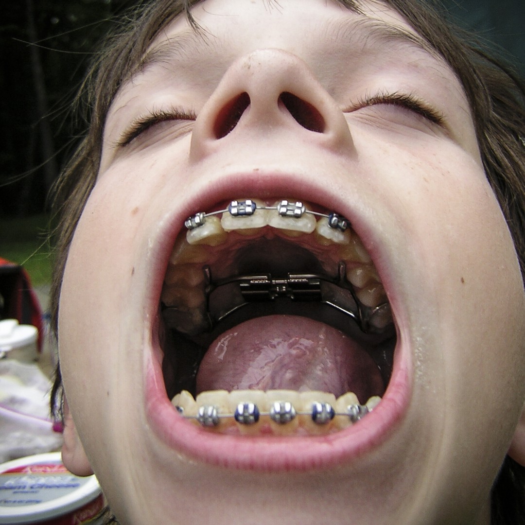 Braces