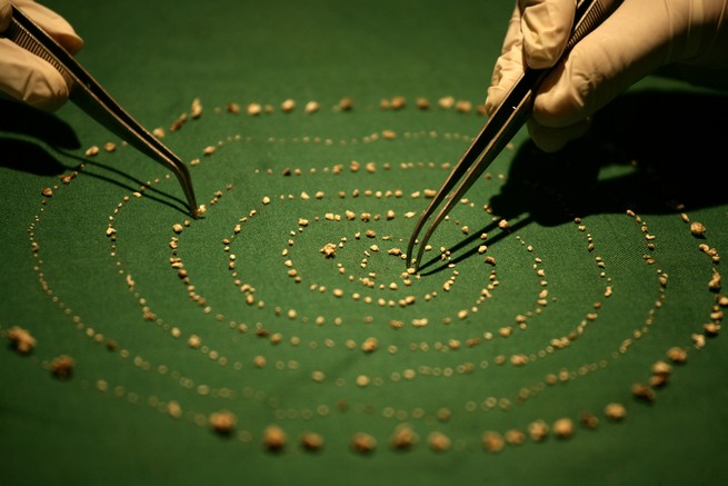 Dentists arrange the 526 extra teeth found in the seven-year-old's mouth into a spiral pattern.