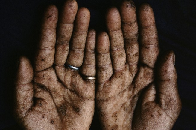 A person's hands with spots from arsenic poisoning