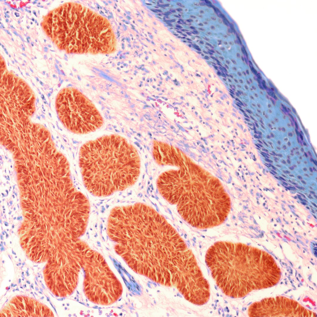 AI-Driven Dermatology Could Leave Dark-Skinned Patients ...