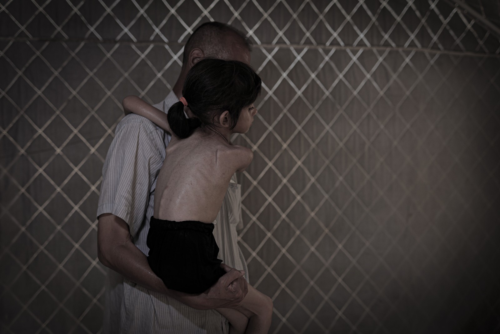 A man holds a severely undernourished child in his arms.