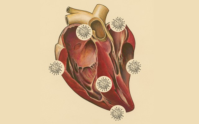 A drawing of a human heart with coronaviruses surrounding it