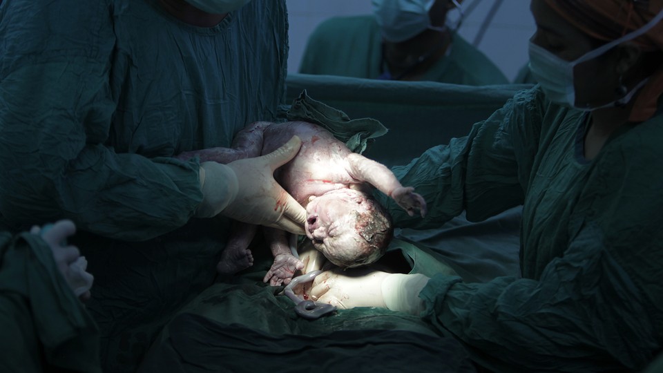 Caesarean section (C-section)