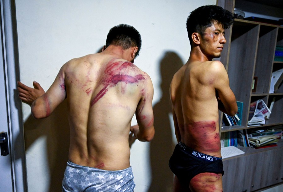 Two men stand in their underwear, showing deep bruises across their bodies.
