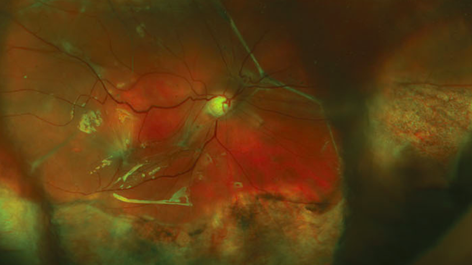 A magnified image of a detached retina