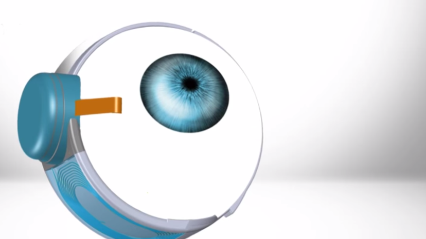 The Woman With the Bionic Eye - The Atlantic