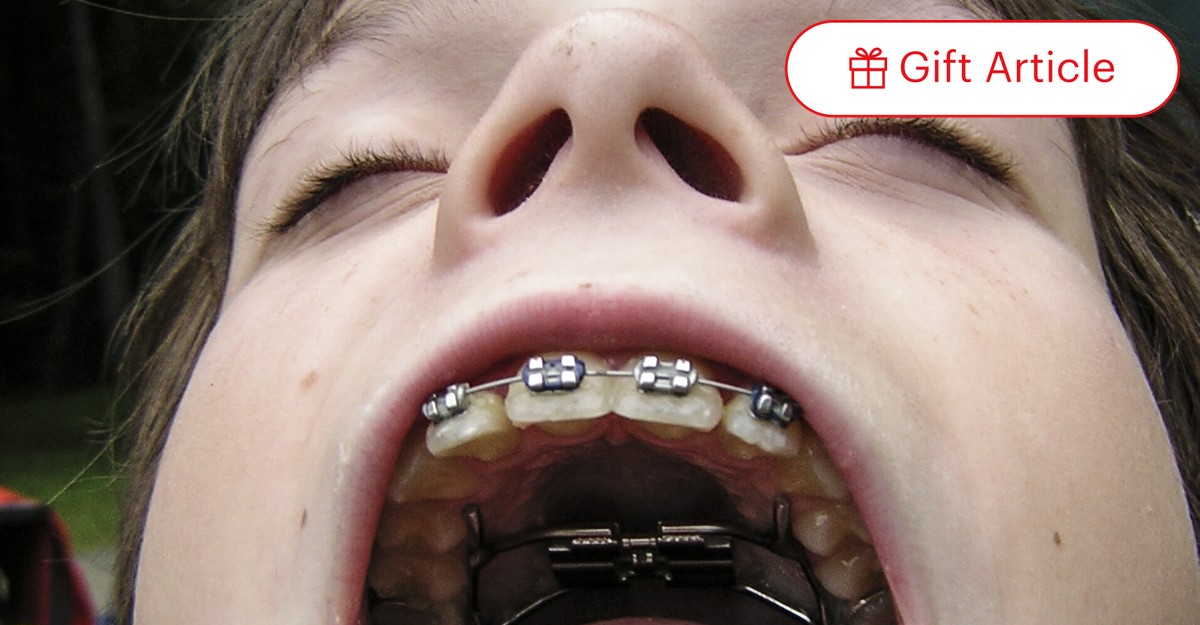 The History of Braces: An Object Lesson - The Atlantic