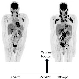 Michel Goldman's CT scan